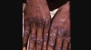 Dokter RSI Banjarnegara Bagikan Tips Mengenali Gejala dan Cara Pencegahan Cacar Monyet