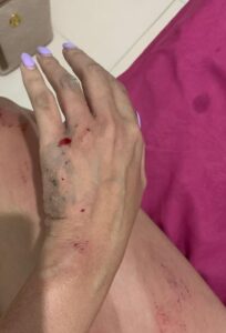 Seorang Wanita di Batam Babak Belur Usai di Tabrak Oleh Mantan Pacarnya, Polisi : Kami Sudah Terima Laporannya