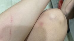 ‎Malam Jahanam di Hotel Penguin: Hanya Karena Rupiah, Pengusaha Importir Batam Tega Hancurkan Wajah Sang Kekasih