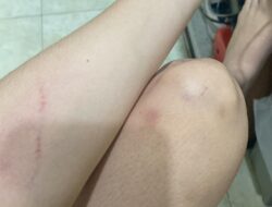 ‎Malam Jahanam di Hotel Penguin: Hanya Karena Rupiah, Pengusaha Importir Batam Tega Hancurkan Wajah Sang Kekasih