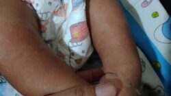 Perjuangan Bayi 8 Bulan Asal Batam di Solo: Pasca-Operasi Kaki Pengkor, Huliyatul Jannah Butuh Uluran Tangan Warga