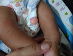 Perjuangan Bayi 8 Bulan Asal Batam di Solo: Pasca-Operasi Kaki Pengkor, Huliyatul Jannah Butuh Uluran Tangan Warga